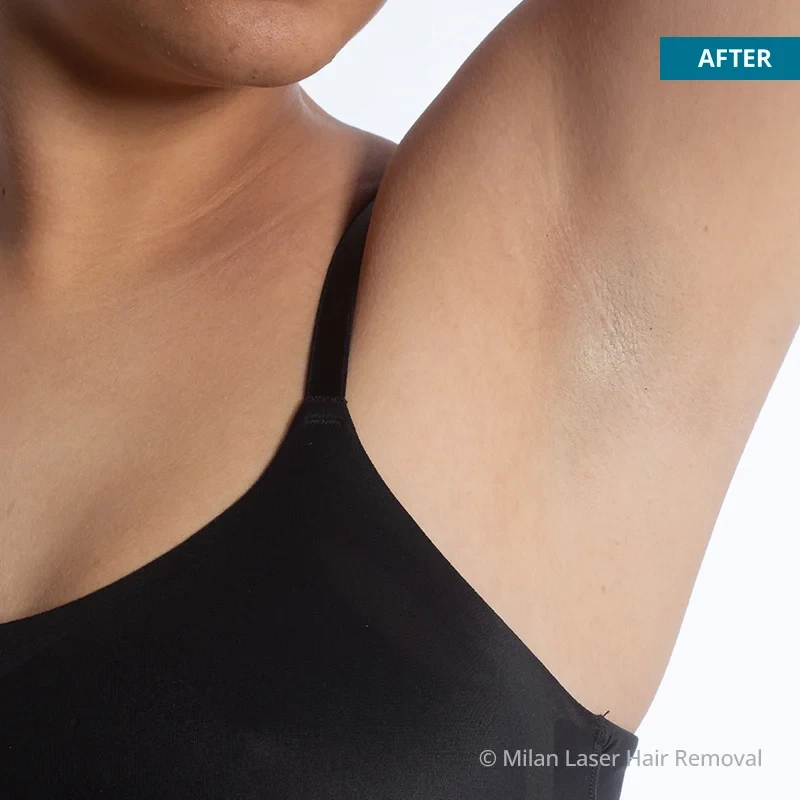 Before and after preview for underarm