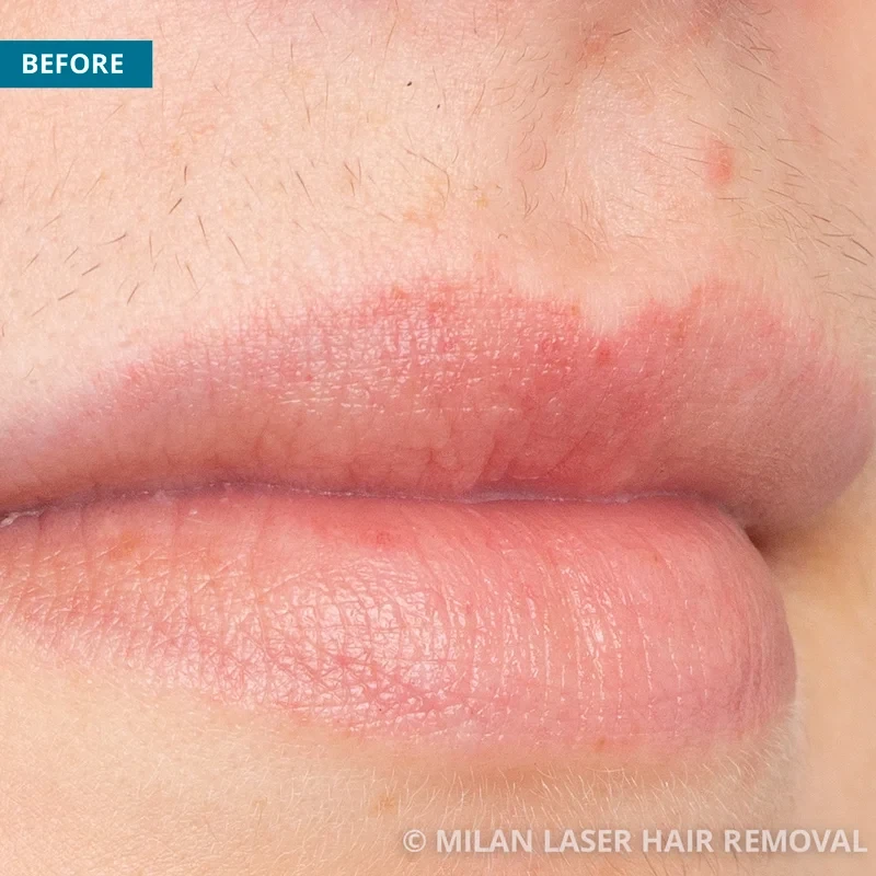 Face Before & After Photos of Laser Hair Removal | Milan Laser in Wichita,  KS